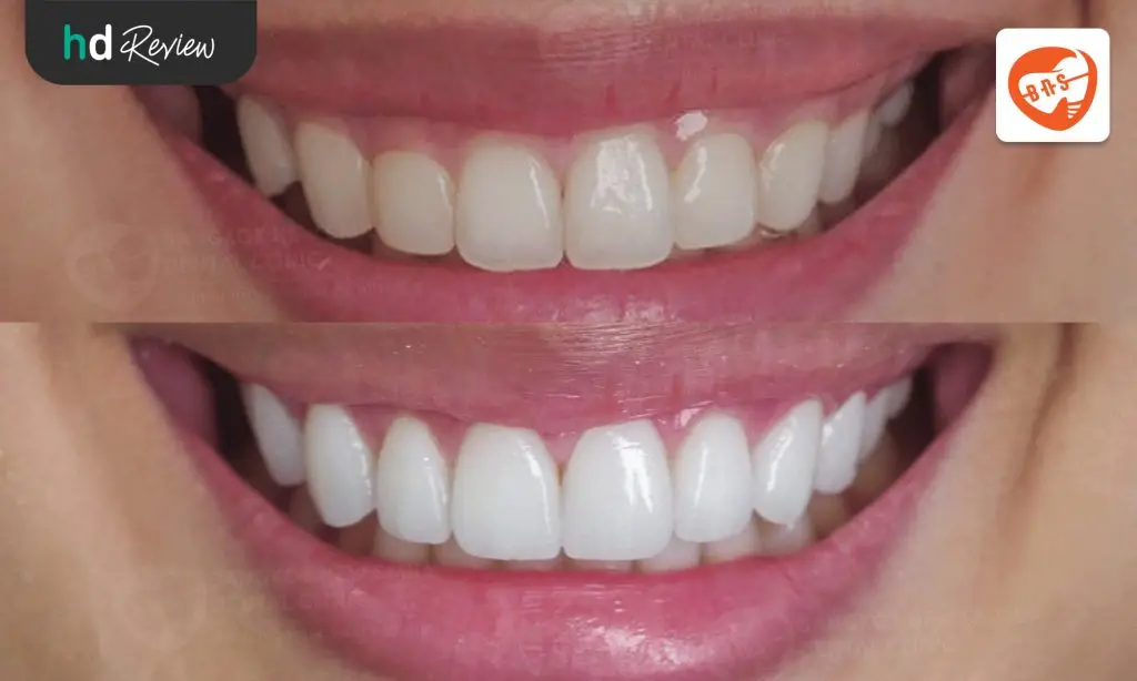 รีวิวเซรามิกวีเนียร์ (Ceramic Veneer) ที่ Bangkok New Smile Dental Clinic