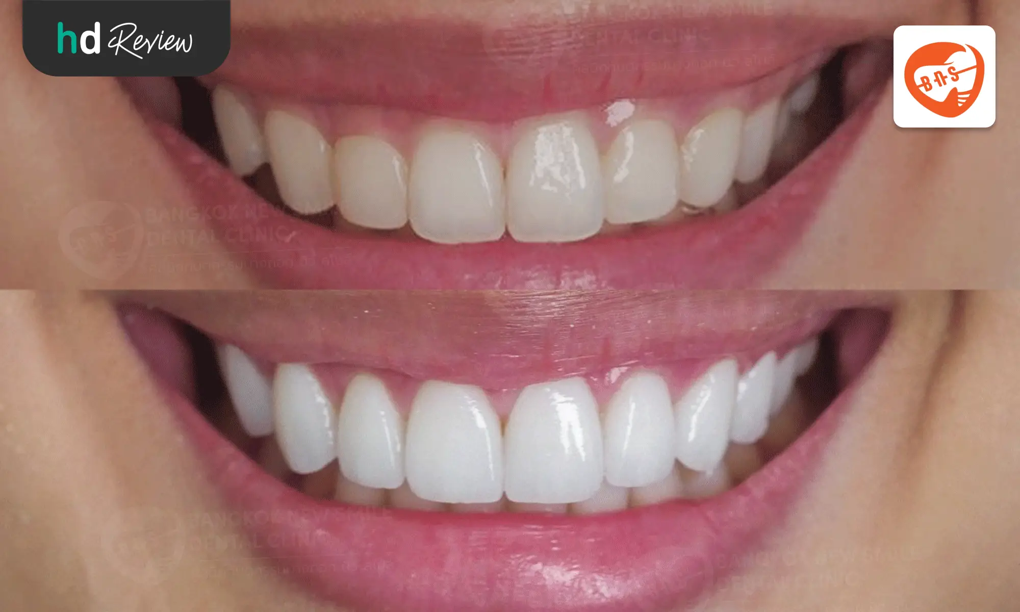 review before after Bangkok New Smile Dental Clinic hero 2