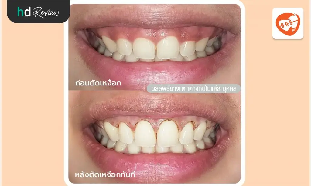 รีวิวตัดเหงือก ที่ Bangkok New Smile Dental Clinic