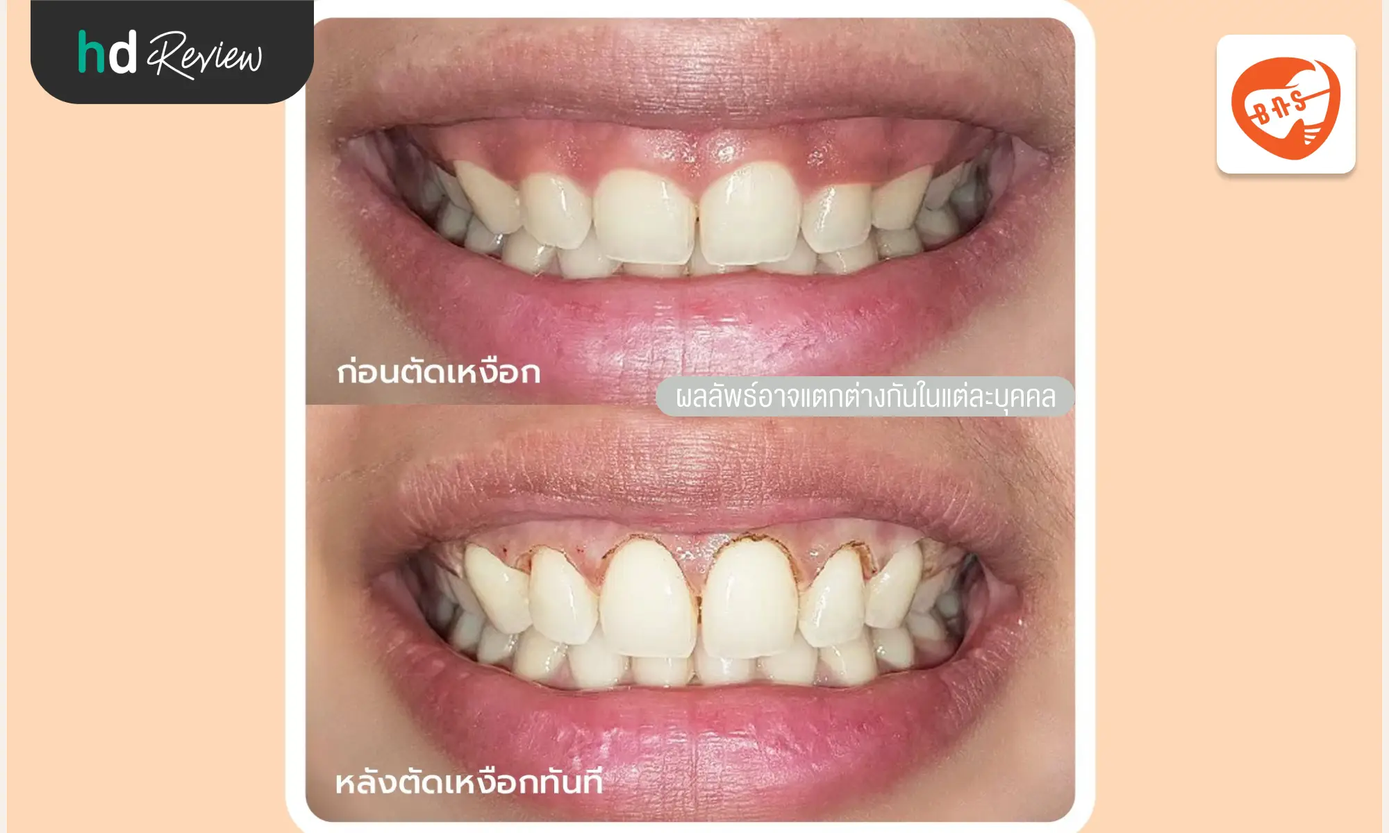 review before after Bangkok New Smile Dental Clinic hero 3