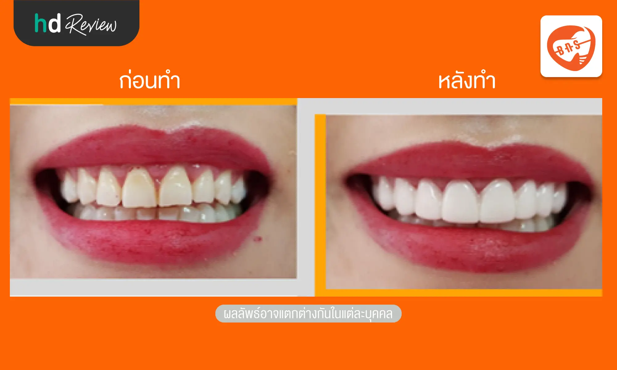 review before after Bangkok New Smile Dental Clinic hero