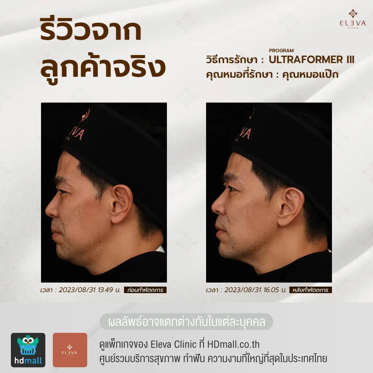 รีวิวยกกระชับหน้าด้วยโปรแกรม Ultraformer III ที่ Eleva Clinic (เอลเลว่า คลินิก) รูปที่ 1