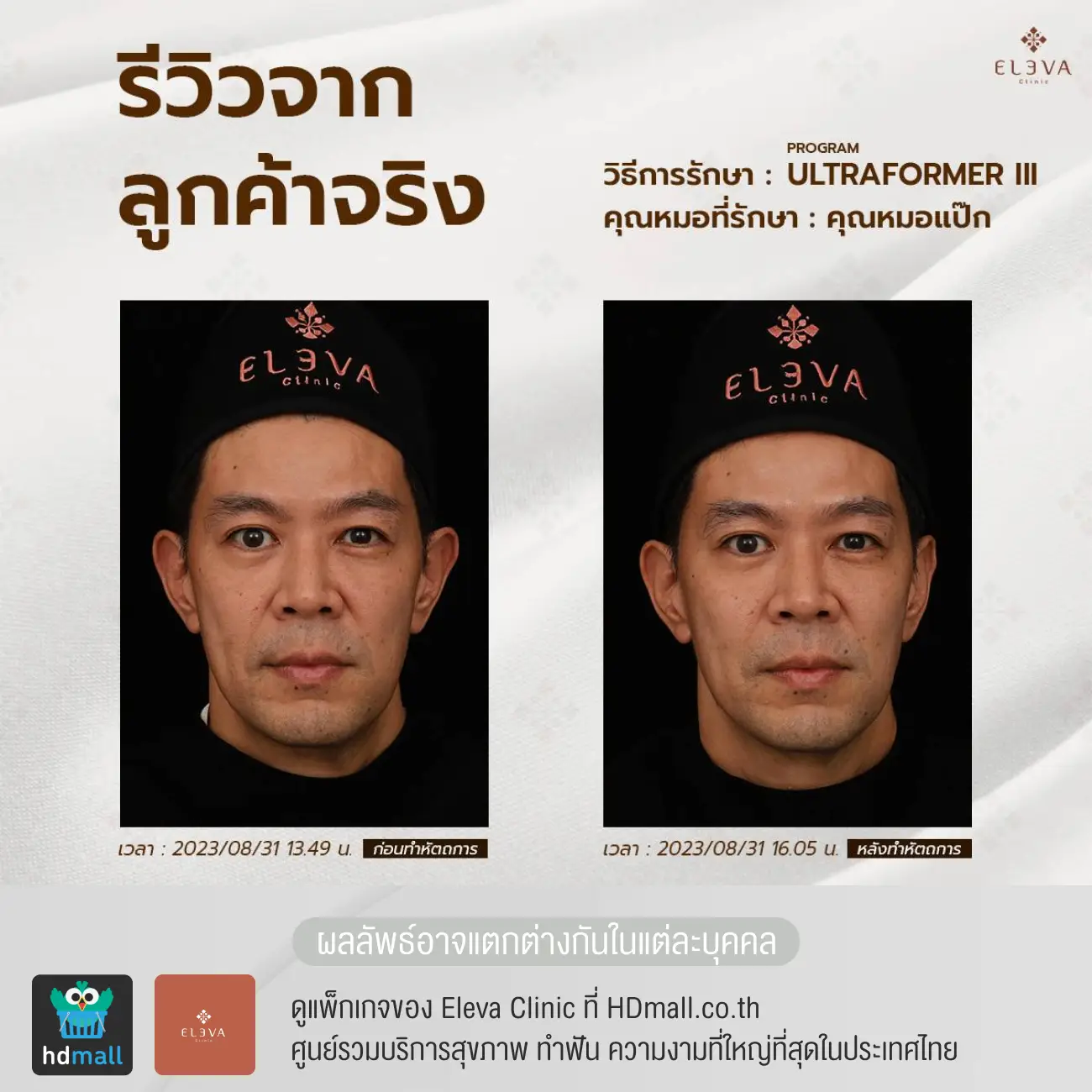 รีวิวยกกระชับหน้าด้วยโปรแกรม Ultraformer III ที่ Eleva Clinic (เอลเลว่า คลินิก) รูปที่ 2