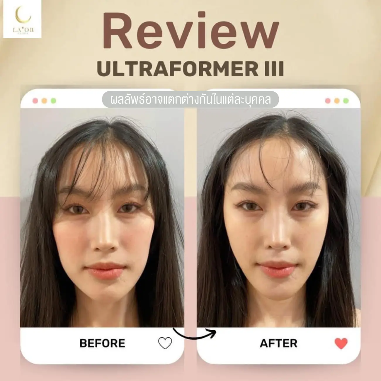 รีวิวยกกระชับหน้าด้วยโปรแกรม Ultraformer III ที่ La’or Wellness & Skin Center รูปที่ 1