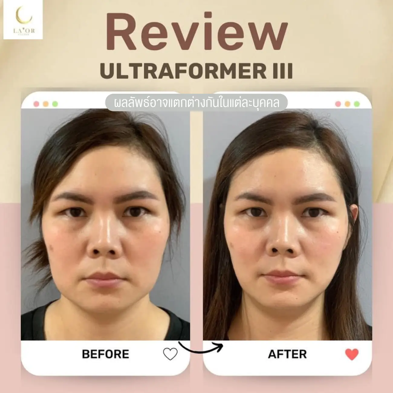 รีวิวยกกระชับหน้าด้วยโปรแกรม Ultraformer III ที่ La’or Wellness & Skin Center รูปที่ 2