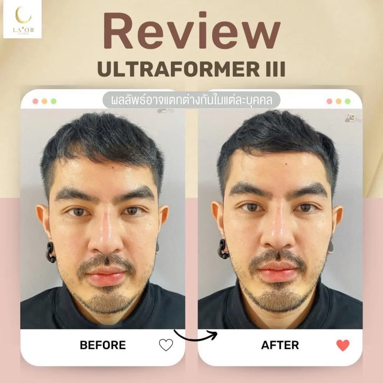 รีวิวยกกระชับหน้าด้วยโปรแกรม Ultraformer III ที่ La’or Wellness & Skin Center รูปที่ 3