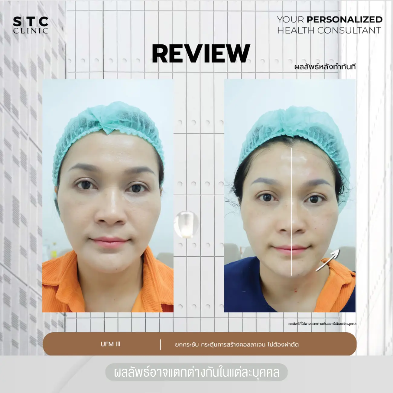 รีวิวยกกระชับหน้าด้วยโปรแกรม Ultraformer III ที่ STC Anti-Aging & Wellness Clinic รูปที่ 1