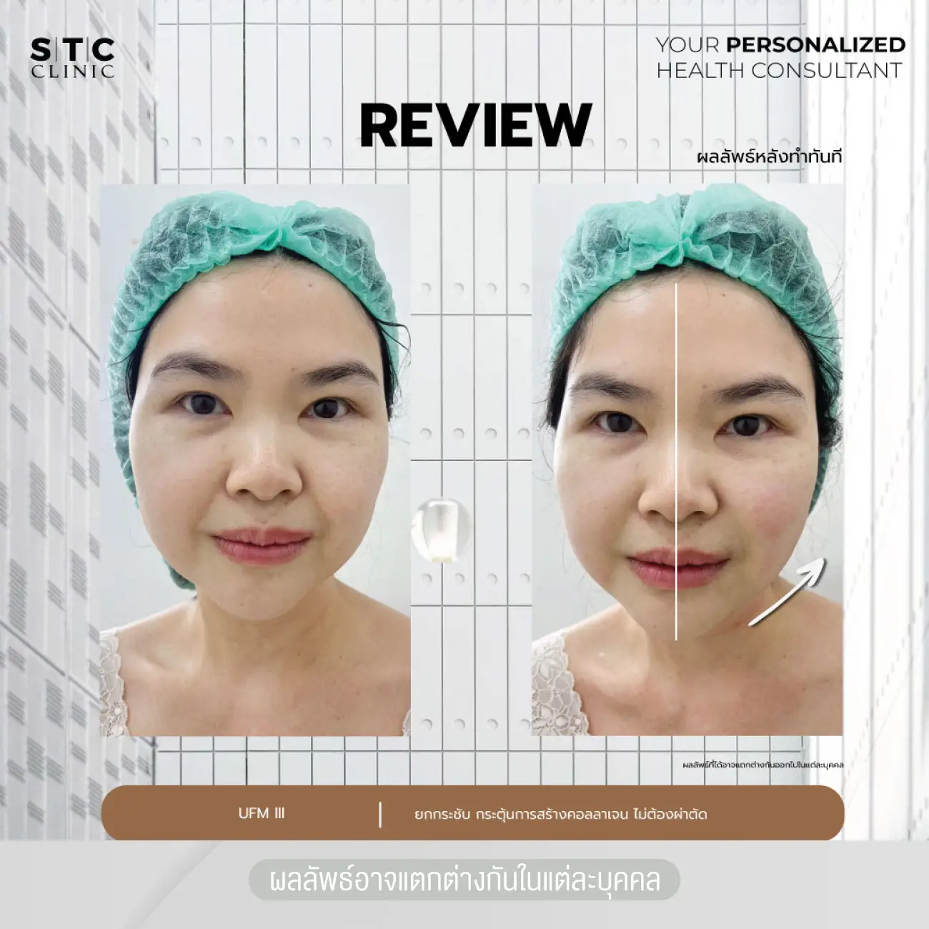 รีวิวยกกระชับหน้าด้วยโปรแกรม Ultraformer III ที่ STC Anti-Aging & Wellness Clinic รูปที่ 2