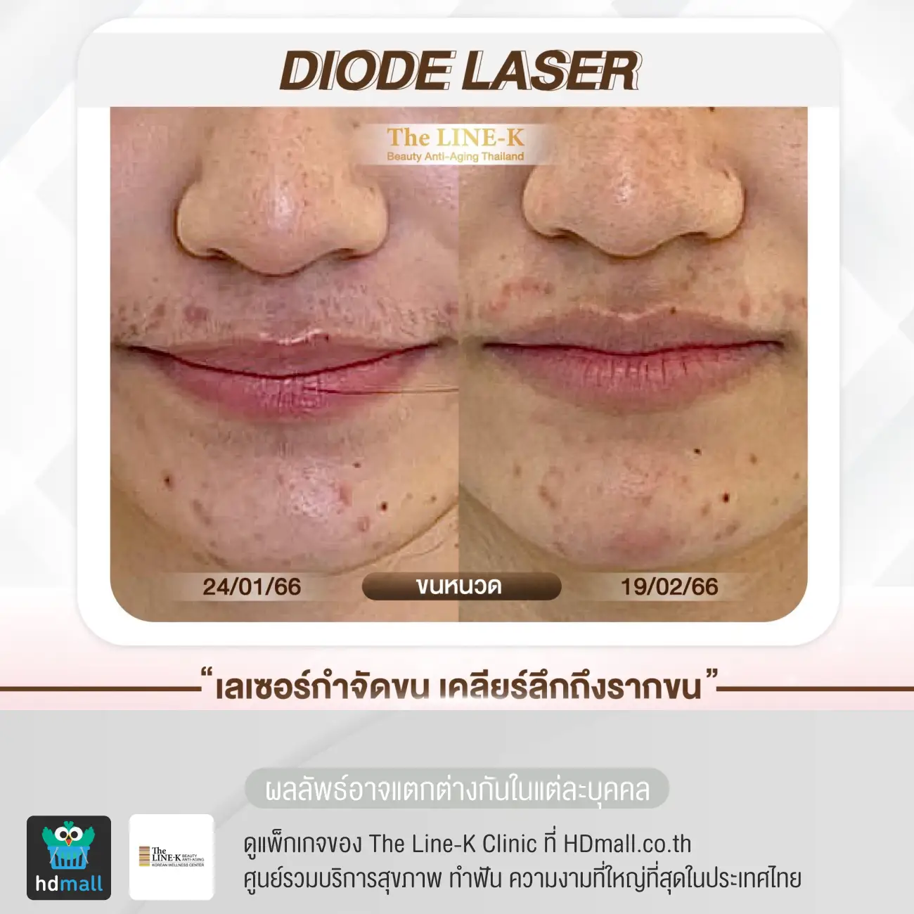 รีวิวเลเซอร์หนวด กำจัดขนด้วย Diode Laser ที่ เดอะไลน์ เค คลินิกเวชกรรม รูปที่ 2