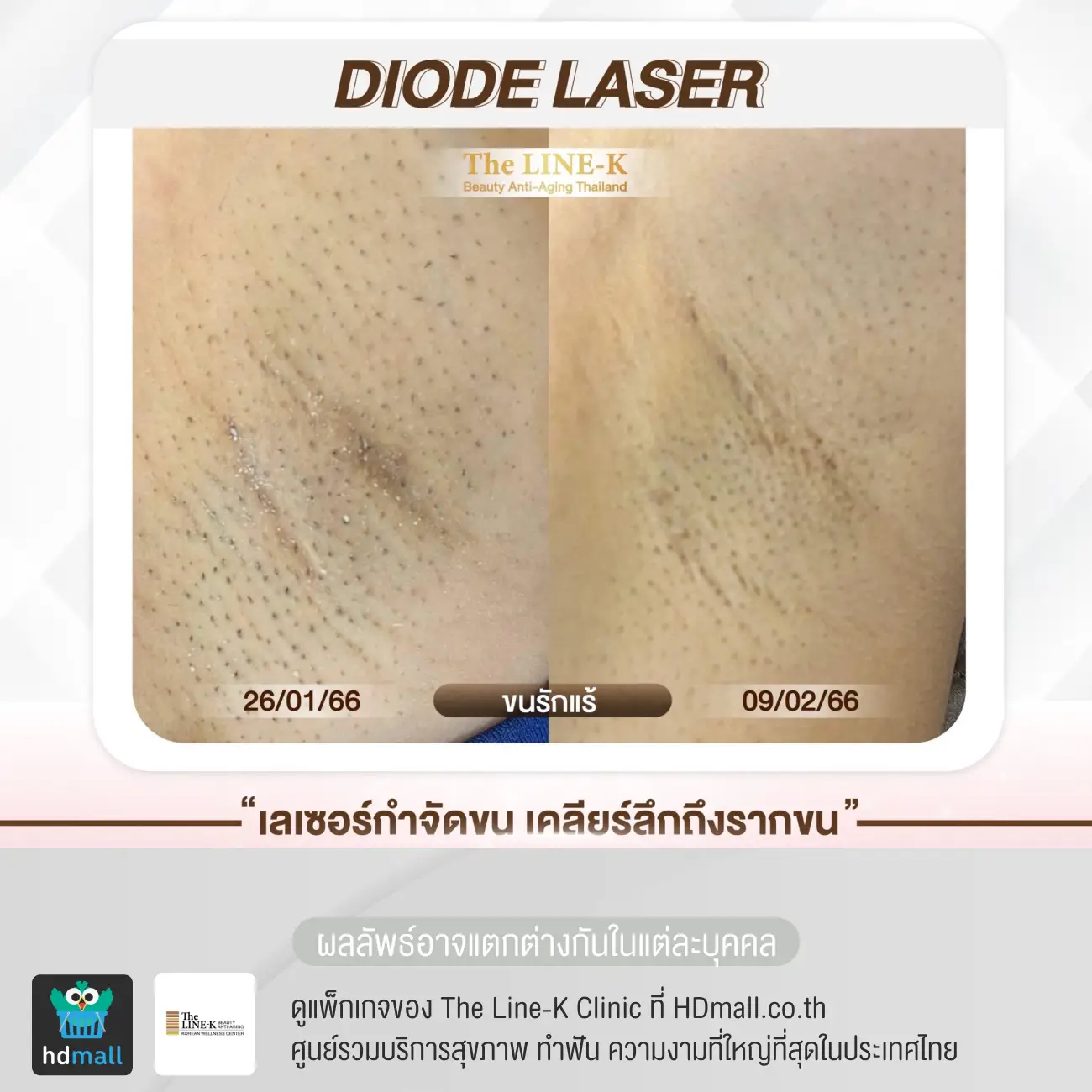 รีวิวกำจัดขนรักแร้ ด้วย Diode Laser ที่ เดอะไลน์ เค คลินิกเวชกรรม รูปที่ 2