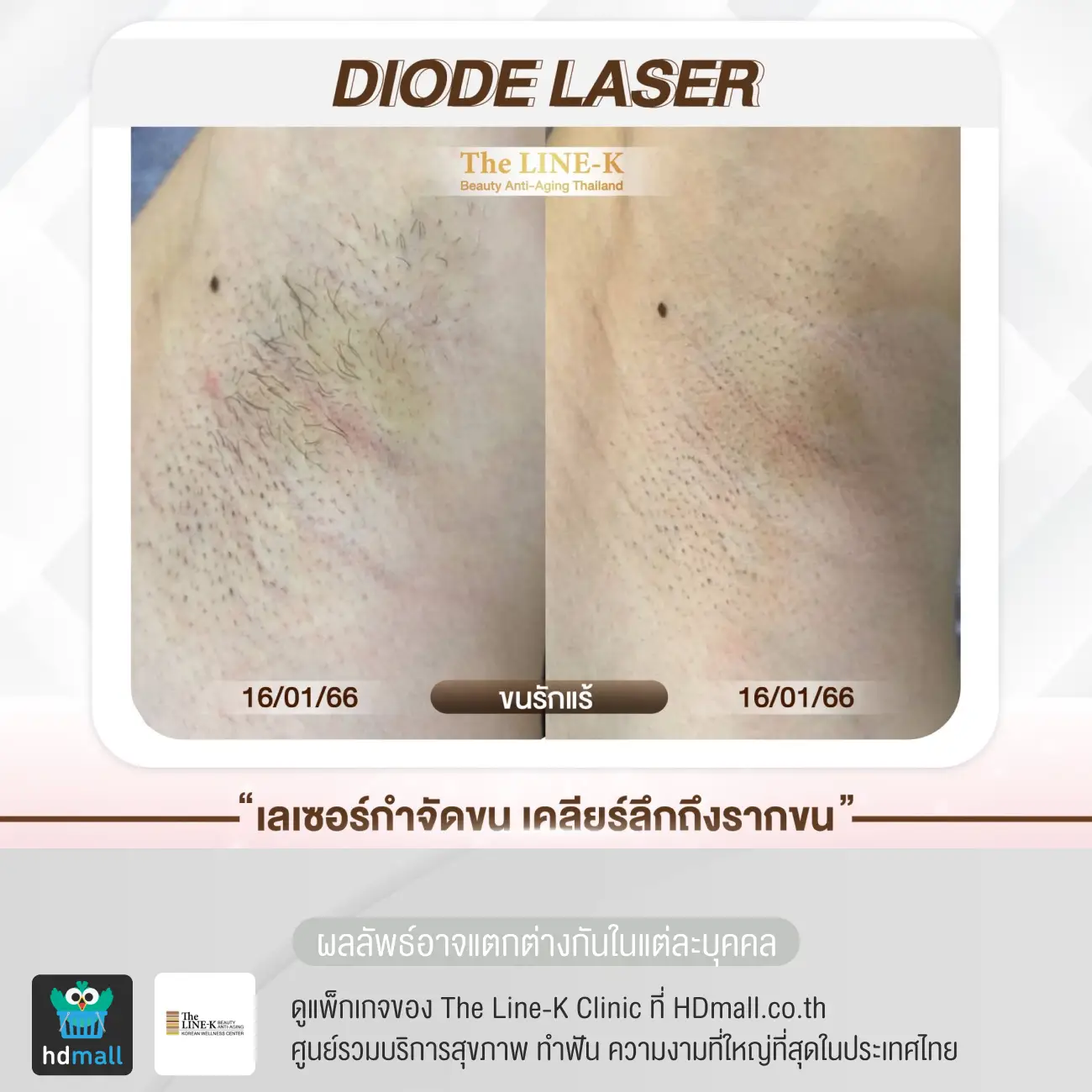 รีวิวกำจัดขนรักแร้ ด้วย Diode Laser ที่ เดอะไลน์ เค คลินิกเวชกรรม รูปที่ 3