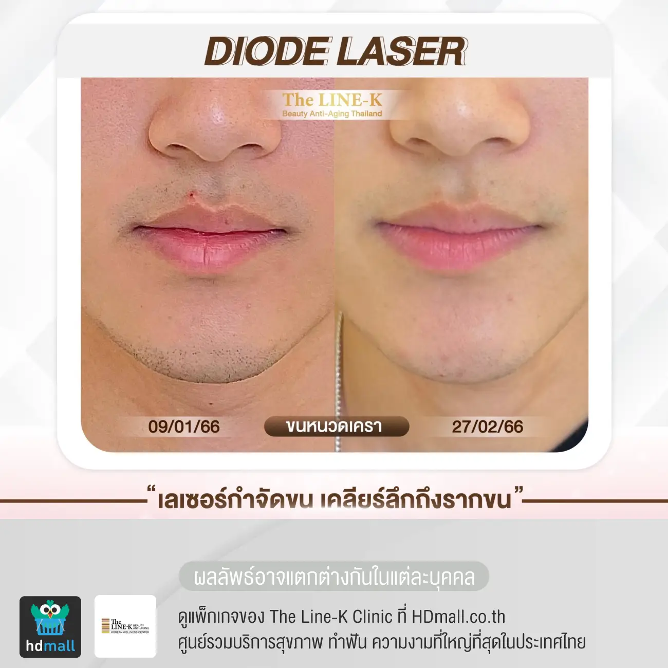 รีวิวเลเซอร์หนวด กำจัดขนด้วย Diode Laser ที่ เดอะไลน์ เค คลินิกเวชกรรม รูปที่ 1