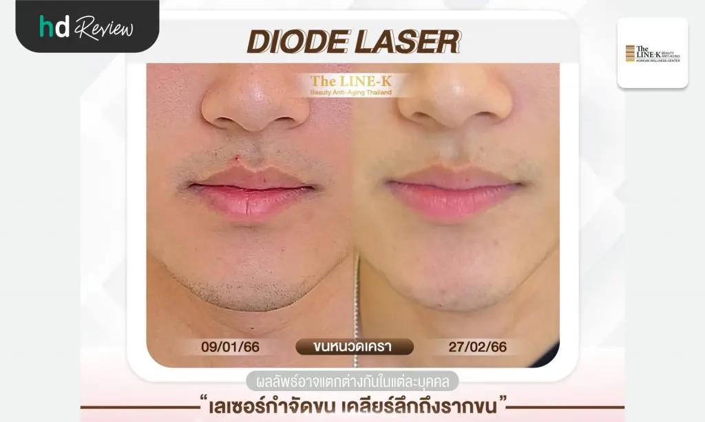 รีวิวเลเซอร์หนวด กำจัดขนด้วย Diode Laser ที่ เดอะไลน์ เค คลินิกเวชกรรม