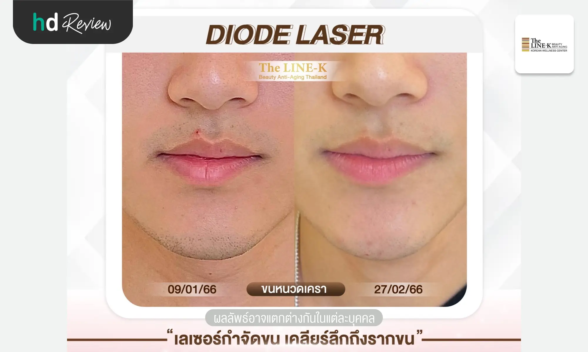 review before after diode laser The Line K hero 1