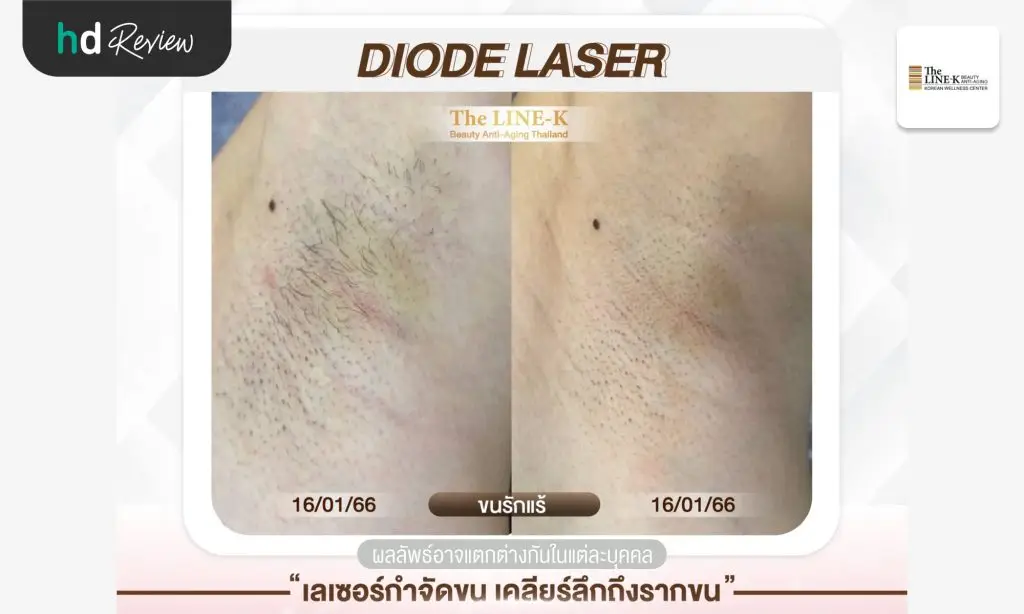 รีวิวกำจัดขนรักแร้ ด้วย Diode Laser ที่ เดอะไลน์ เค คลินิกเวชกรรม