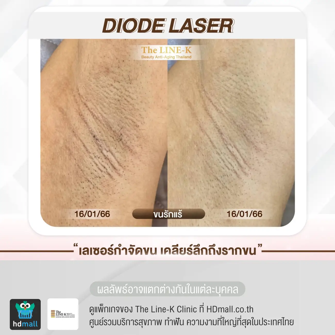 รีวิวกำจัดขนรักแร้ ด้วย Diode Laser ที่ เดอะไลน์ เค คลินิกเวชกรรม รูปที่ 1