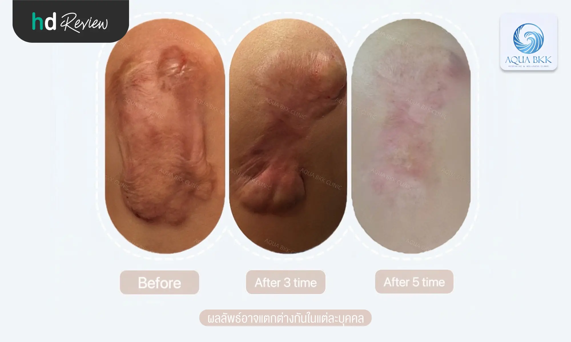 review before after keloid AQUA BKK Aesthetic Wellness Clinic hero