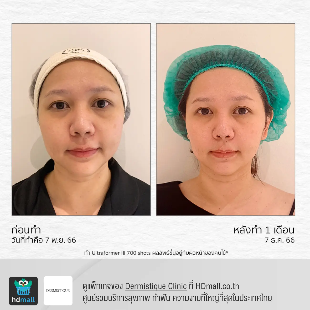 รีวิวยกกระชับหน้าด้วยโปรแกรม Ultraformer III ที่ DERMISTIQUE รูปที่ 6