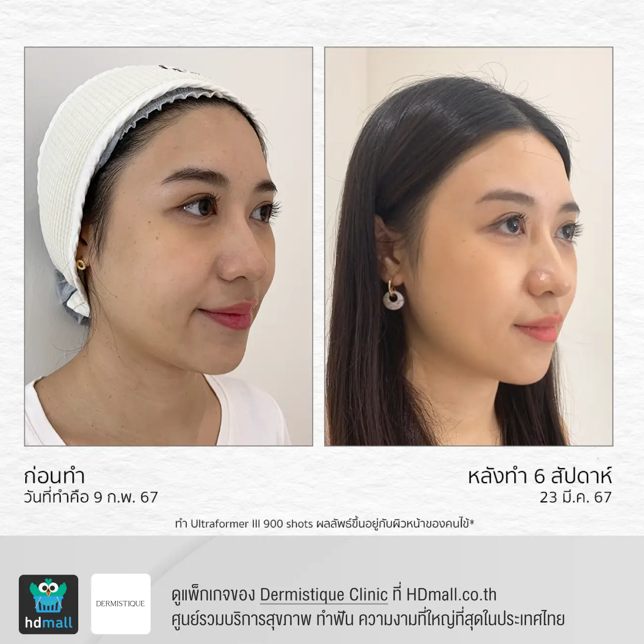 รีวิวยกกระชับหน้าด้วยโปรแกรม Ultraformer III ที่ DERMISTIQUE รูปที่ 2