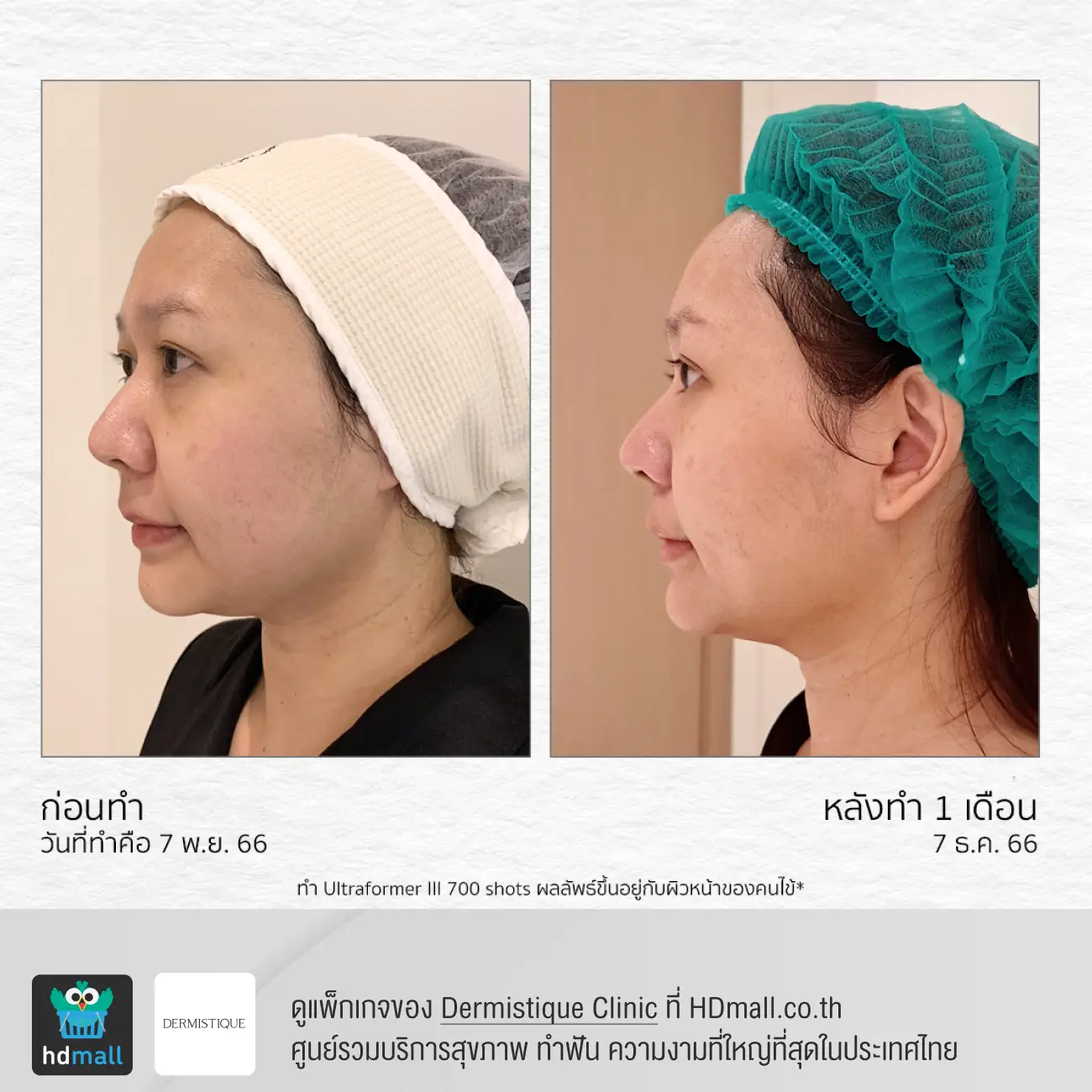 รีวิวยกกระชับหน้าด้วยโปรแกรม Ultraformer III ที่ DERMISTIQUE รูปที่ 4