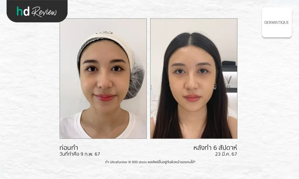 รีวิวยกกระชับหน้าด้วยโปรแกรม Ultraformer III ที่ DERMISTIQUE