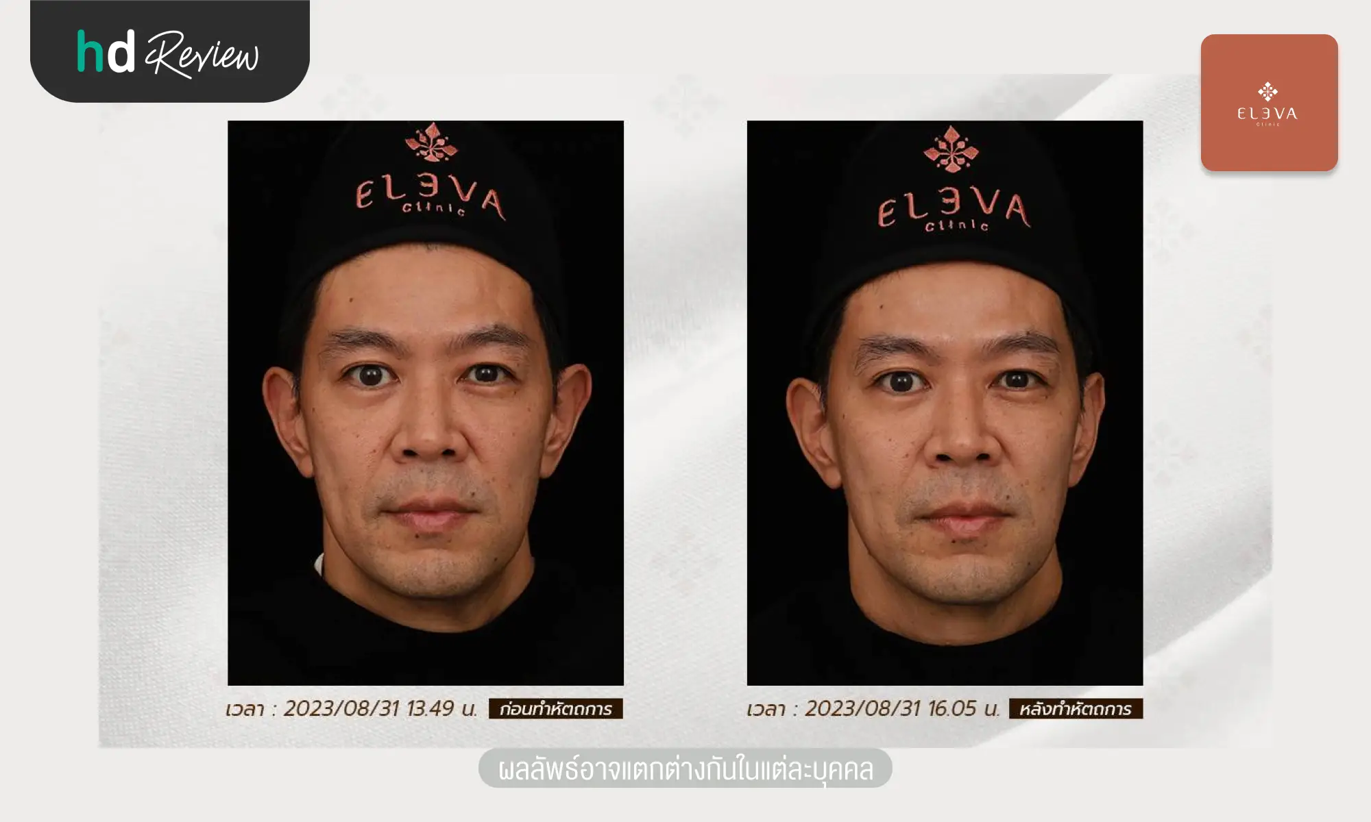 review before after ultraformeriii Eleva Clinic hero