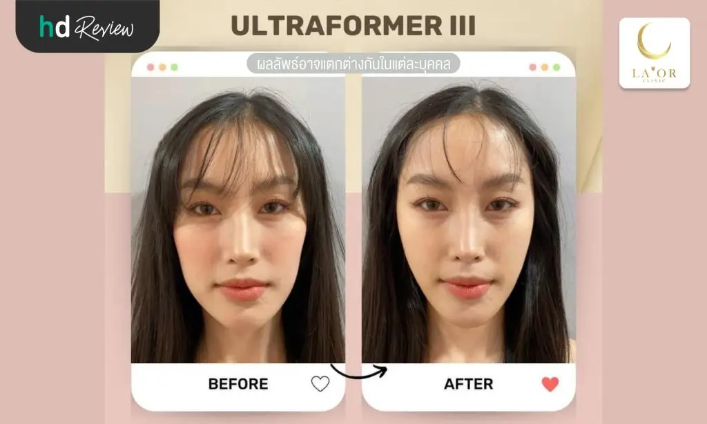 รีวิวยกกระชับหน้าด้วยโปรแกรม Ultraformer III ที่ La’or Wellness & Skin Center