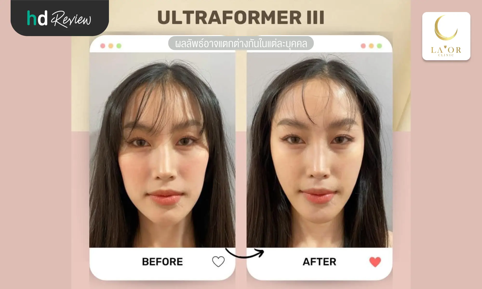 review before after ultraformeriii Laor Wellness Skin Center hero