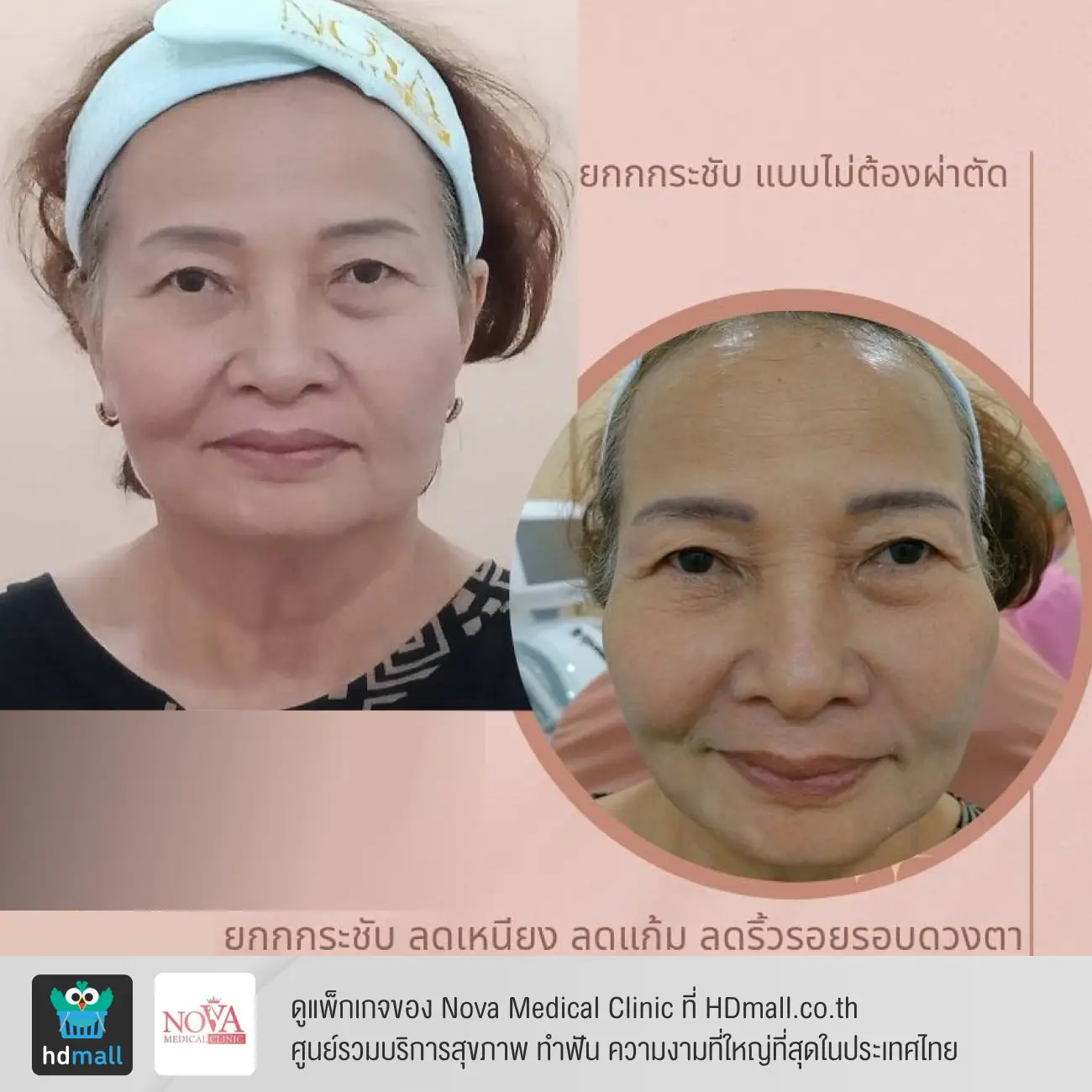 รีวิวยกกระชับหน้าด้วยโปรแกรม Ultraformer III ที่ Nova Medical Clinic รูปที่ 2