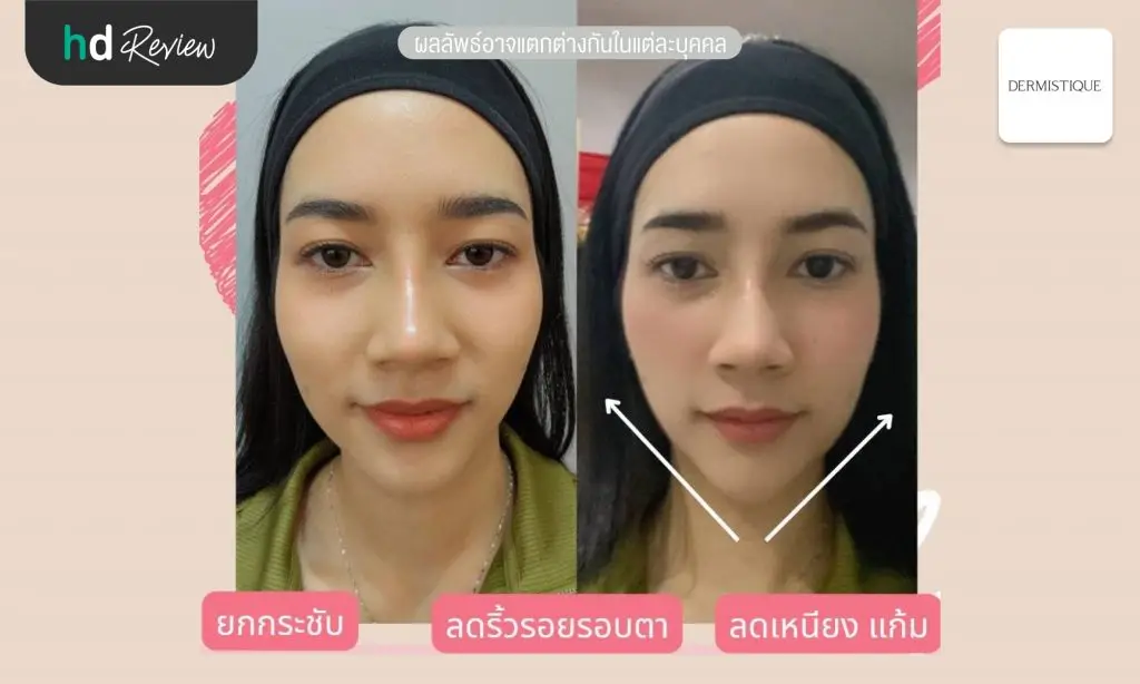 รีวิวยกกระชับหน้าด้วยโปรแกรม Ultraformer III ที่ Nova Medical Clinic