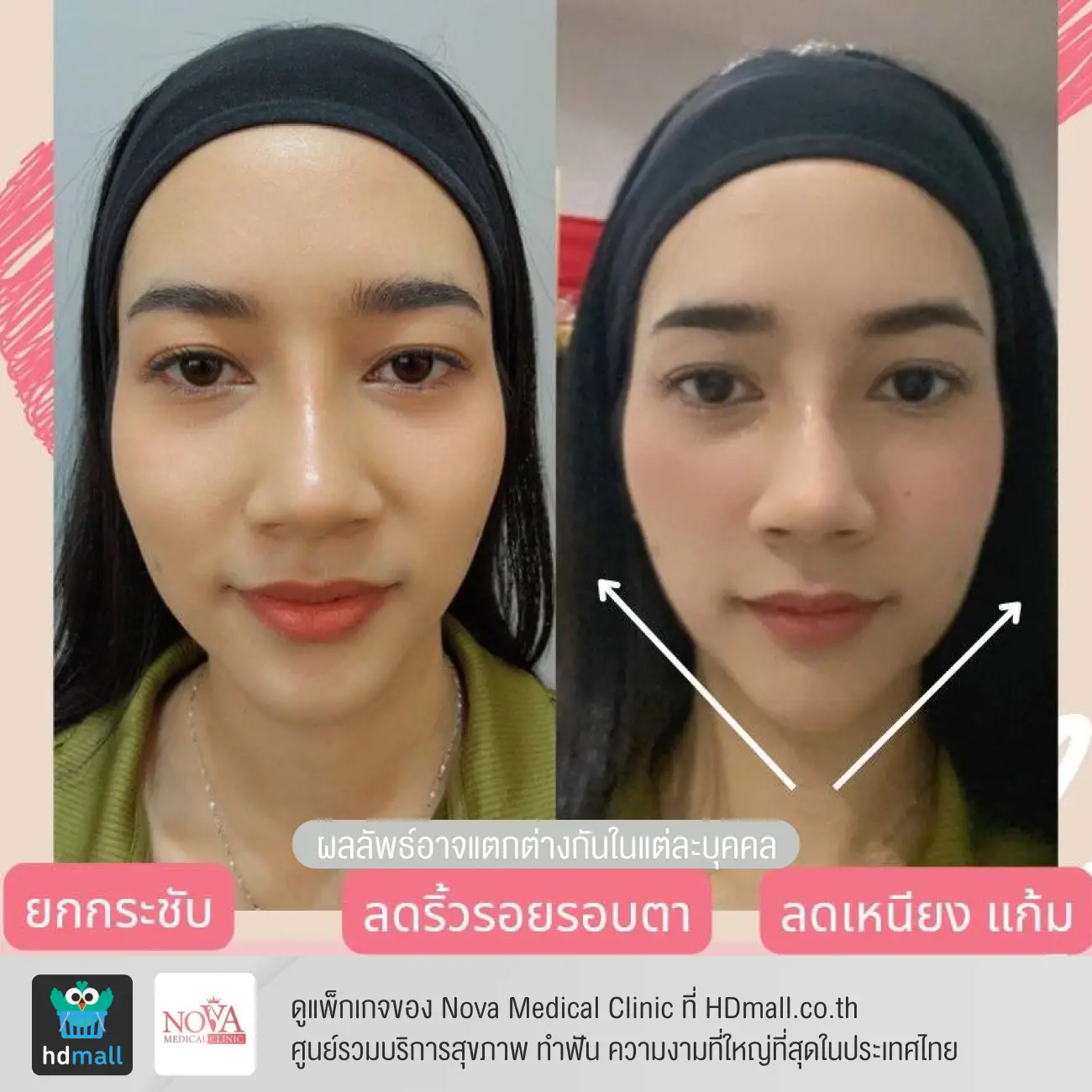 รีวิวยกกระชับหน้าด้วยโปรแกรม Ultraformer III ที่ Nova Medical Clinic รูปที่ 1