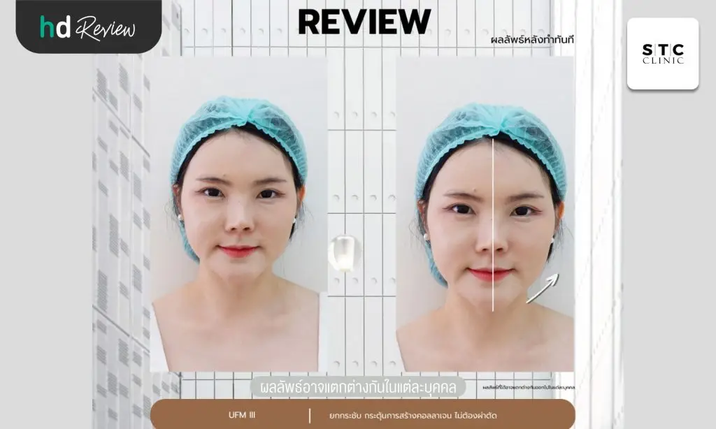 รีวิวยกกระชับหน้าด้วยโปรแกรม Ultraformer III ที่ STC Anti-Aging & Wellness Clinic