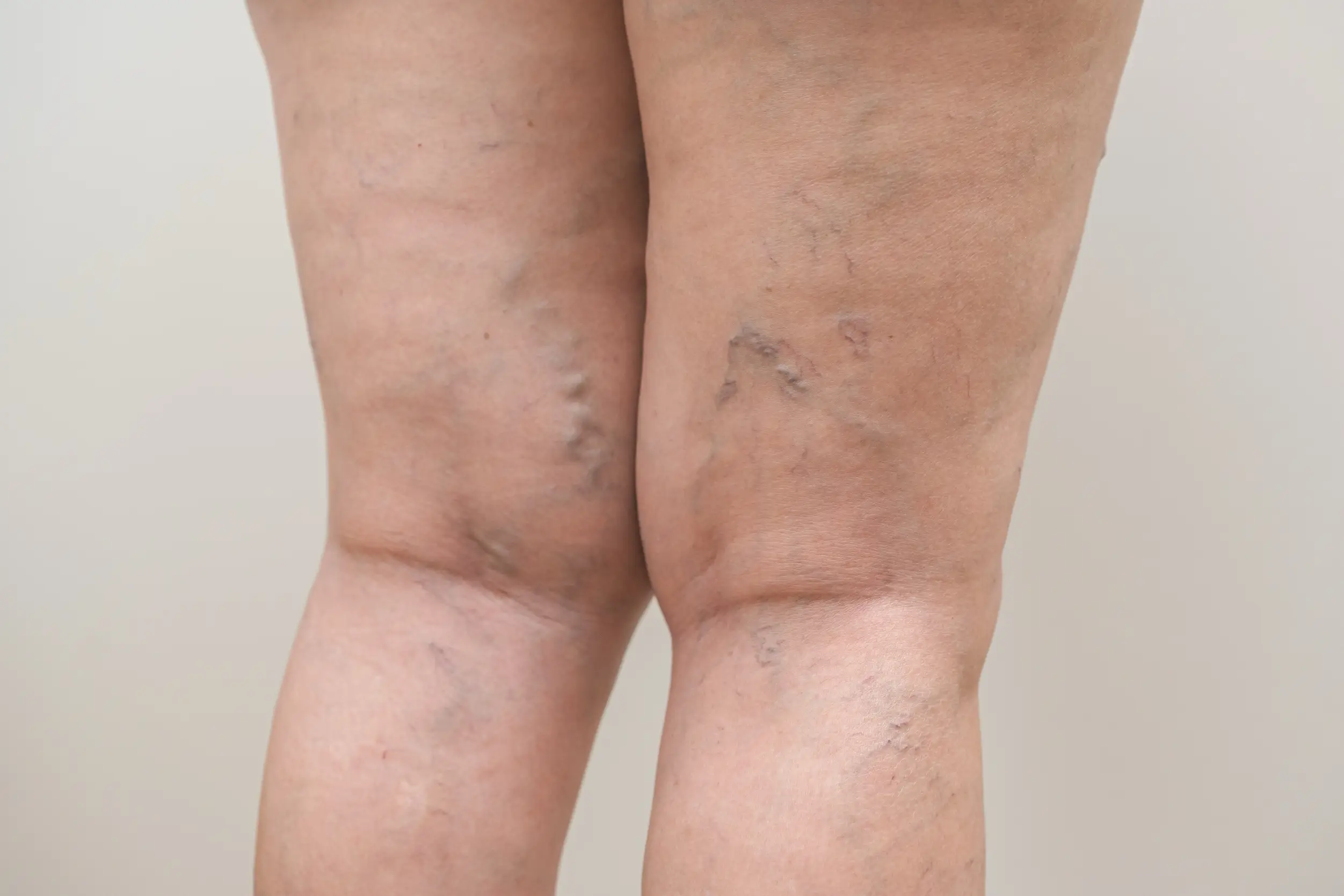 varicose veins disease definition