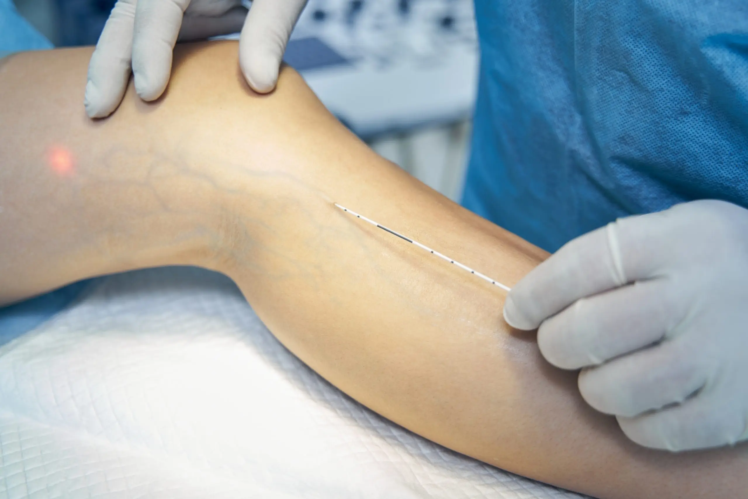 varicose veins rf surgery treatment comparison scaled