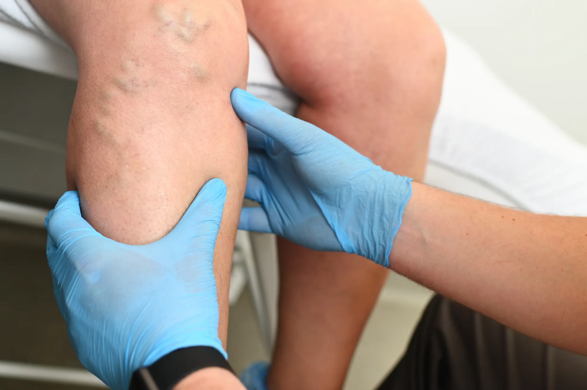 varicose veins screening selfcheck