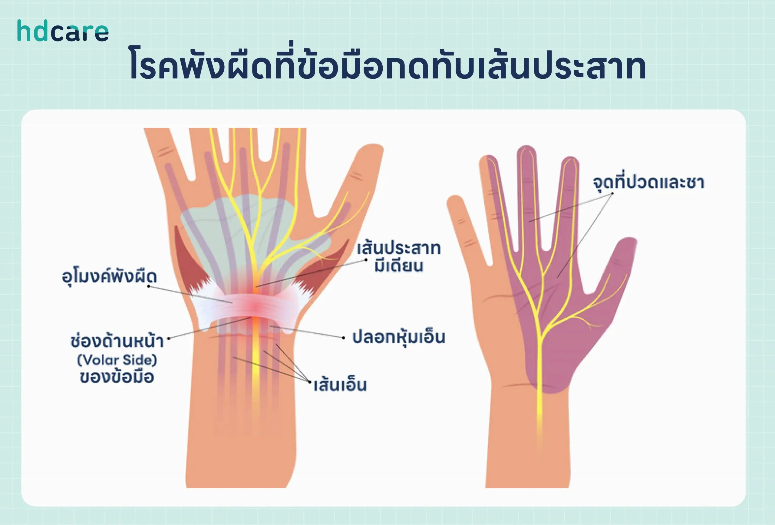 ปวดมือ มือชา สัญญาณโรคพังผืดที่มือกดทับเส้นประสาท