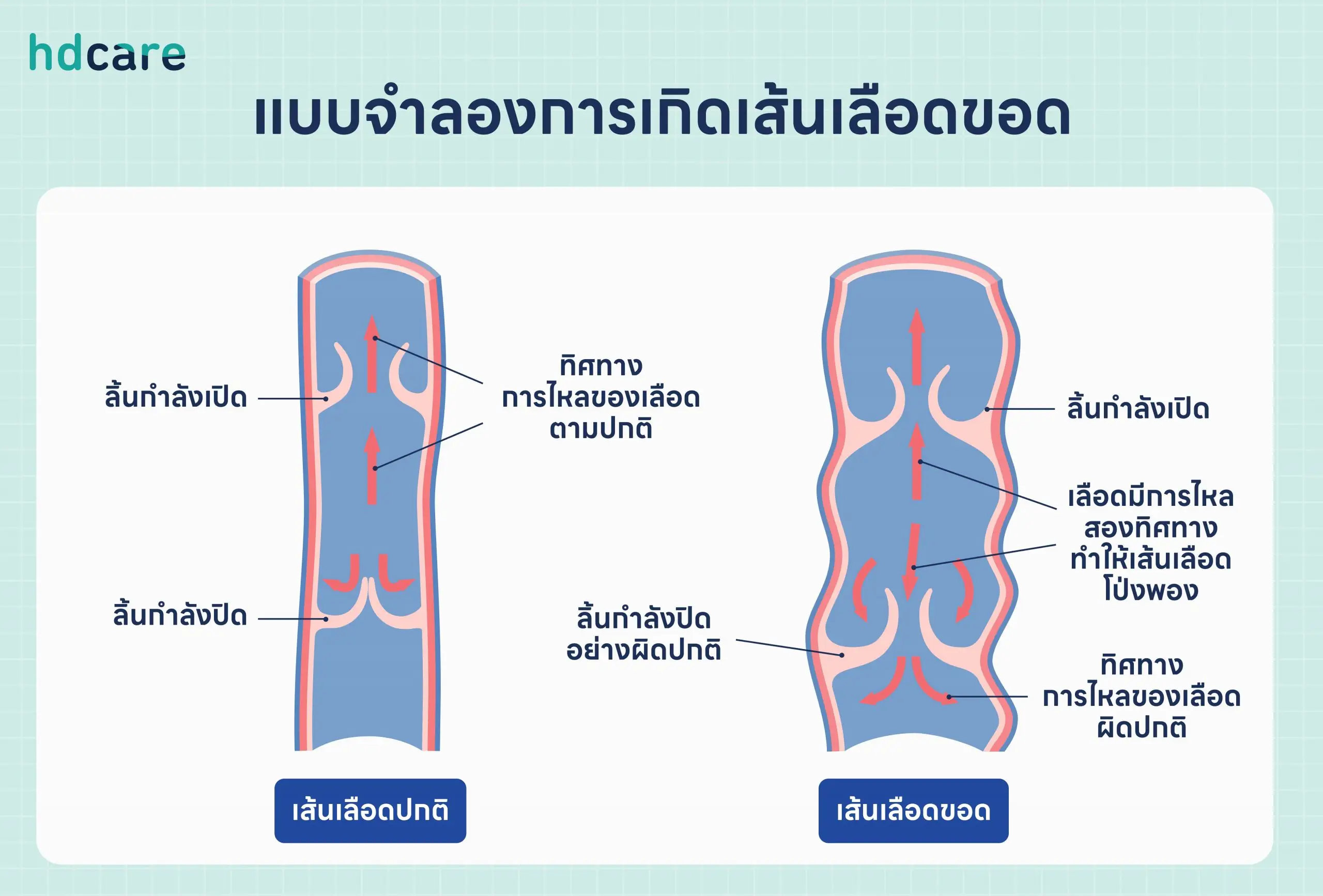 เส้นเลือดขอดคืออะไร สาเหตุ อาการ การตรวจ วิธีรักษา วิธีป้องกัน