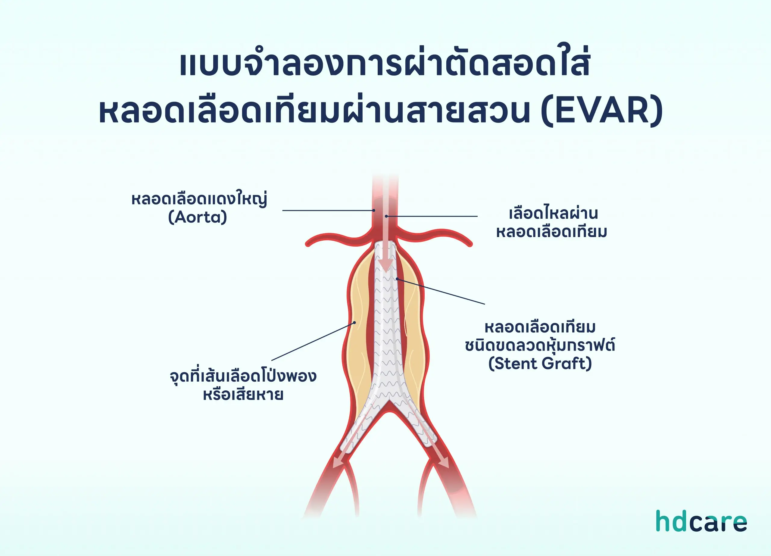 การผ่าตัดสอดใส่หลอดเลือดเทียมผ่านสายสวน (EVAR)