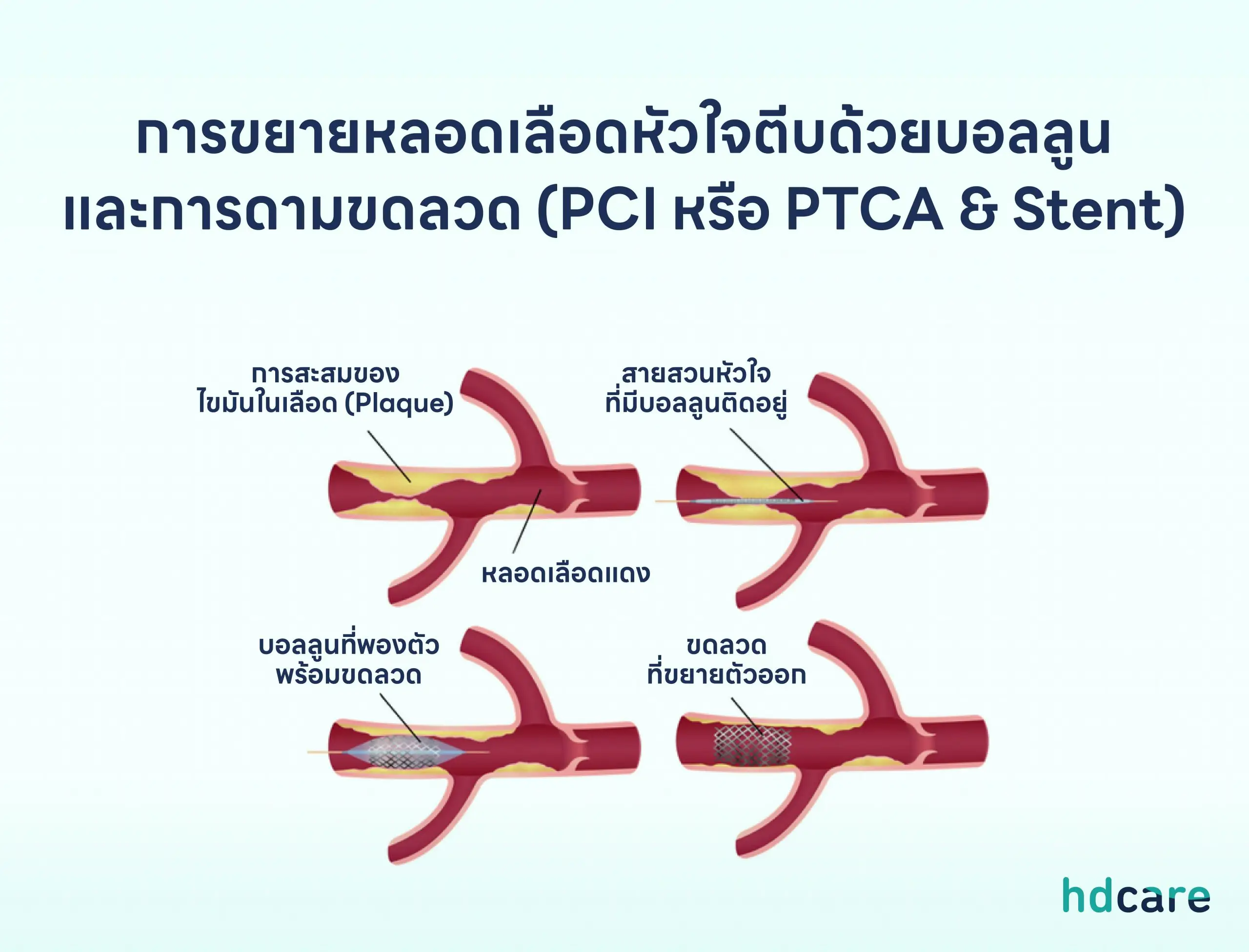 การขยายหลอดเลือดหัวใจตีบด้วยบอลลูน