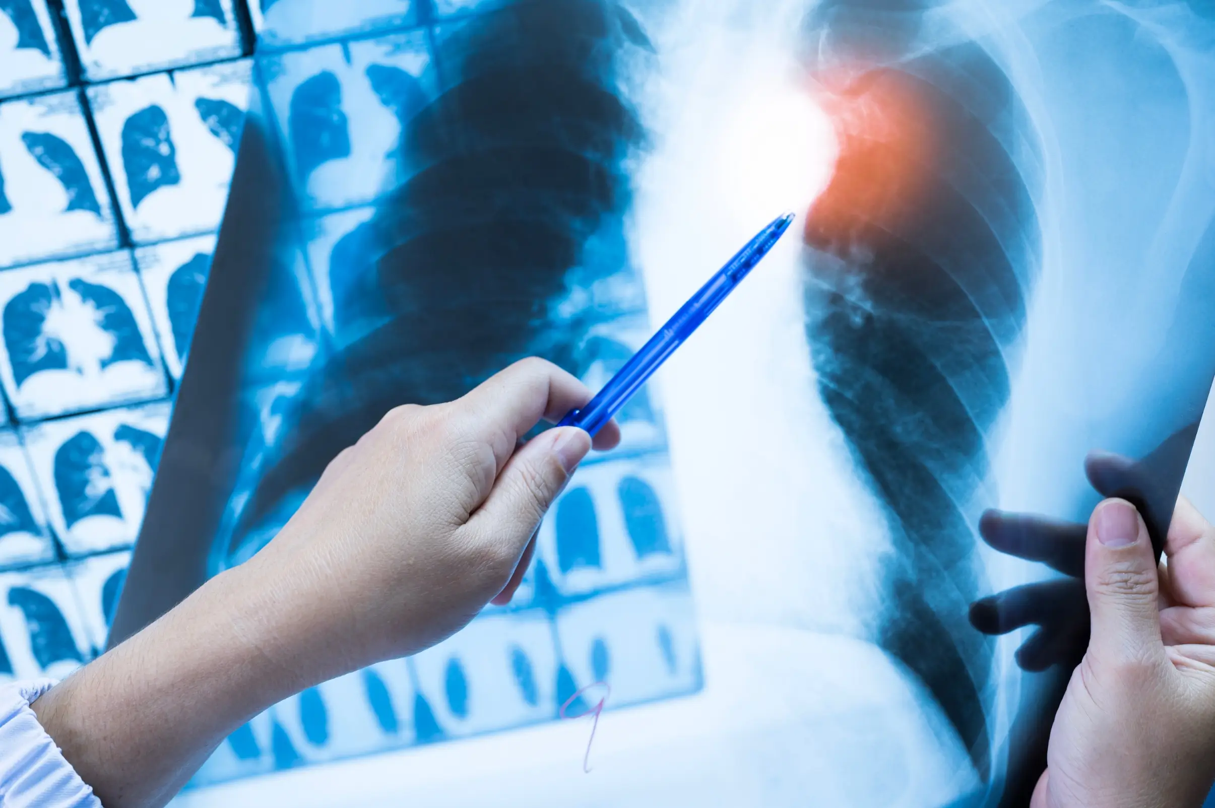 chest x ray and low dose ct scan screening comparison