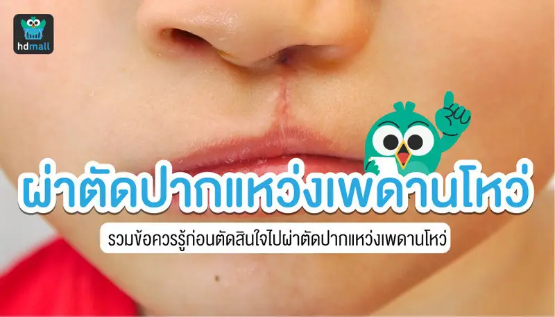 ผ่าตัดปากแหว่ง