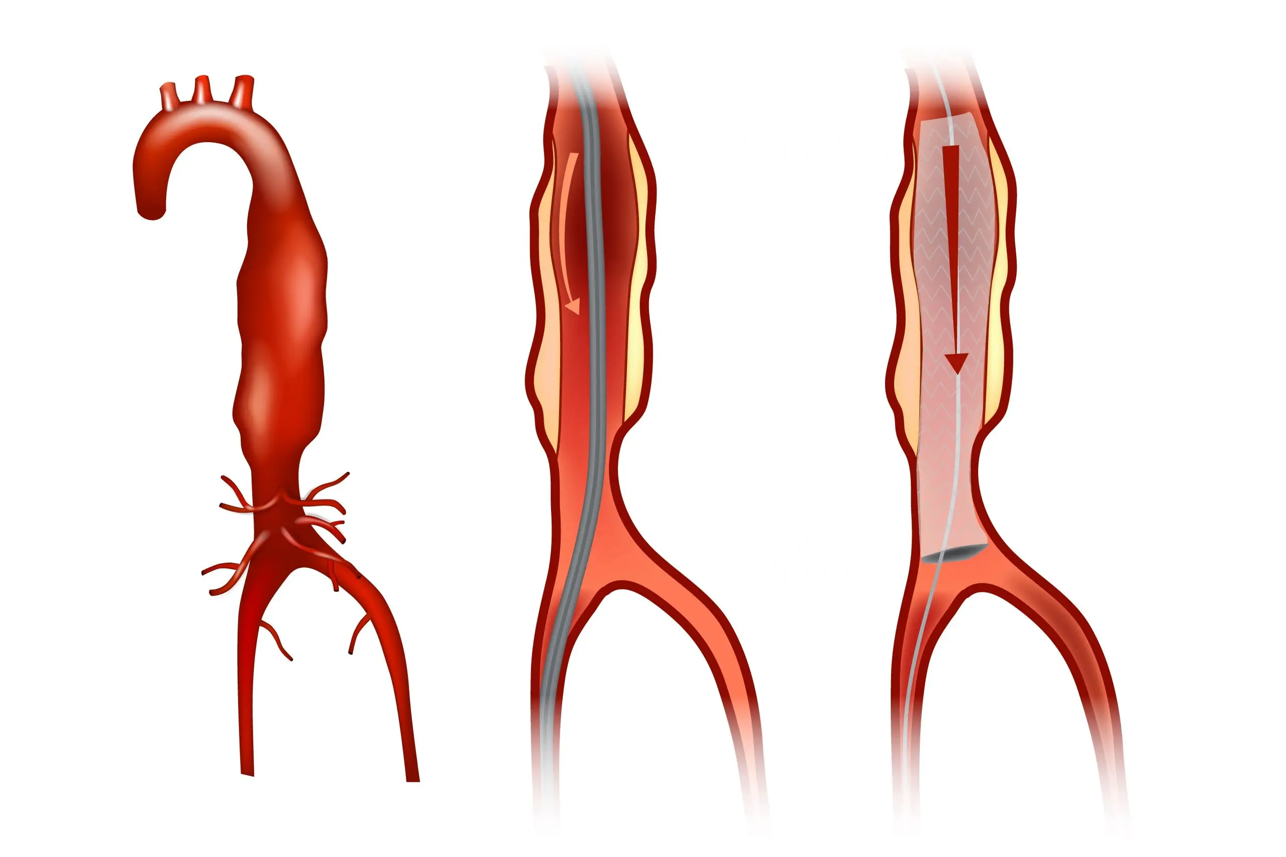 evar treatment process scaled