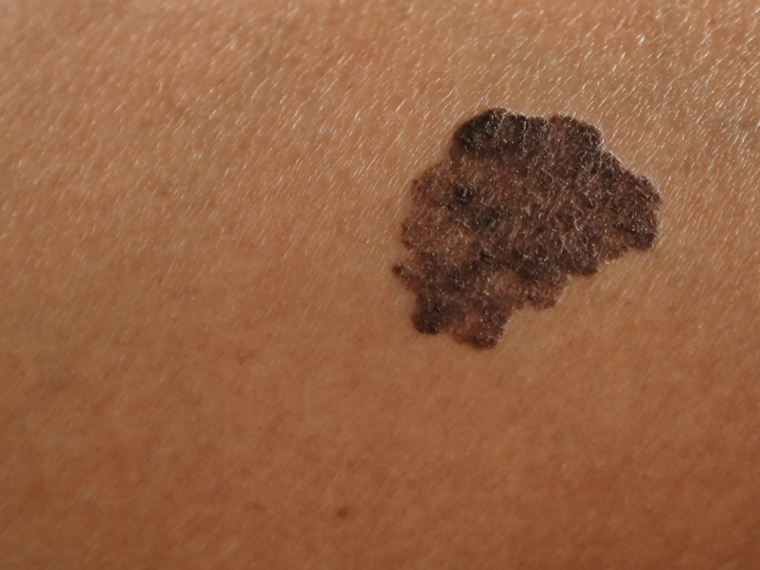 moles or melanoma skin cancer disease definition scaled