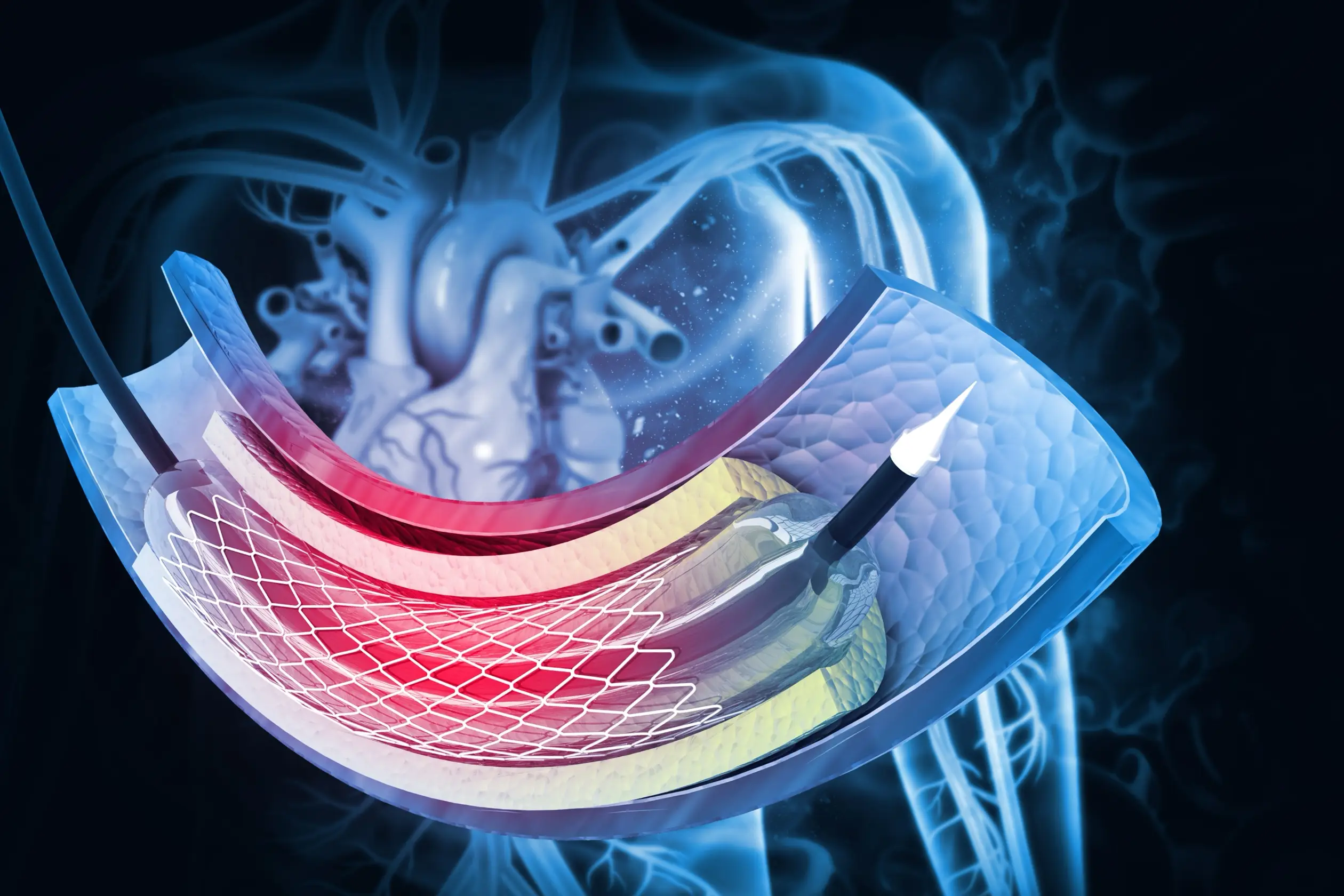 pci treatment process