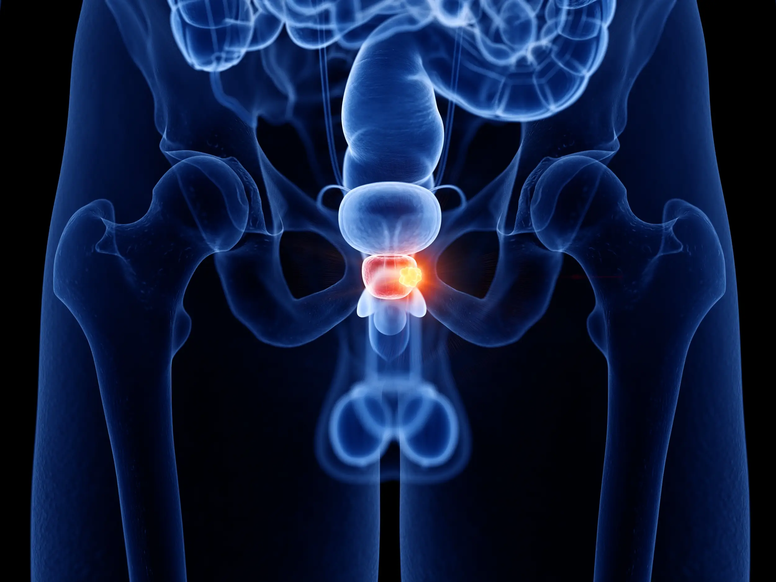 prostate cancer men disease definition