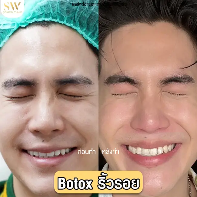 รีวิวฉีดโบท็อกซ์ลดริ้วรอย ที่ Sowon Clinic รูปที่ 1