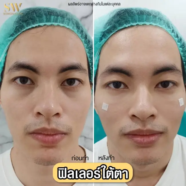 รีวิวฉีดฟิลเลอร์ใต้ตา ที่ Sowon Clinic รูป 2