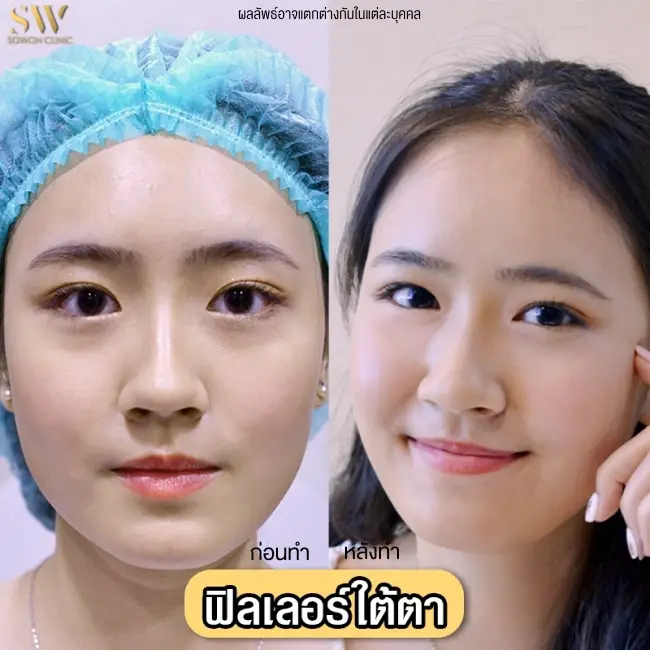 รีวิวฉีดฟิลเลอร์ใต้ตา ที่ Sowon Clinic รูป 1