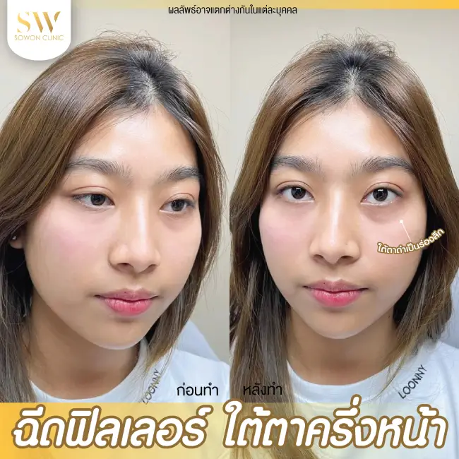 รีวิวฉีดฟิลเลอร์ใต้ตา ที่ Sowon Clinic รูป 5