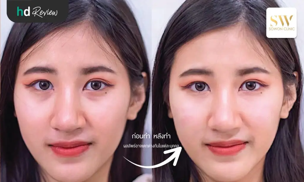 รีวิวโปรแกรมฉีดฟิลเลอร์ใต้ตา ที่ Sowon Clinic